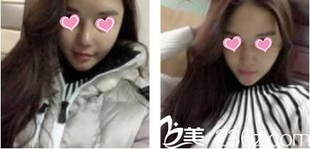 韓國金在中整形外科金在中假體隆鼻真人案例術后第七天