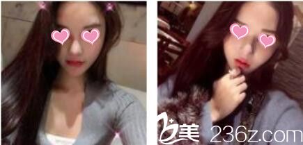 韓國金在中整形外科金在中假體隆鼻真人案例術后一個月