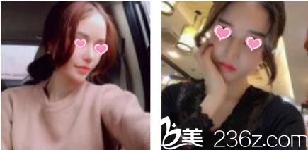 韓國金在中隆鼻技術(shù)好不好？看看兩個月前做的假體隆鼻恢復(fù)效果圖