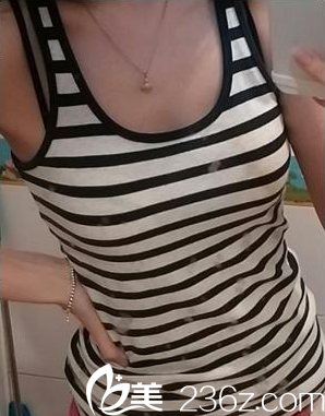 沒做豐胸手術前的我 沒做豐胸手術前的我