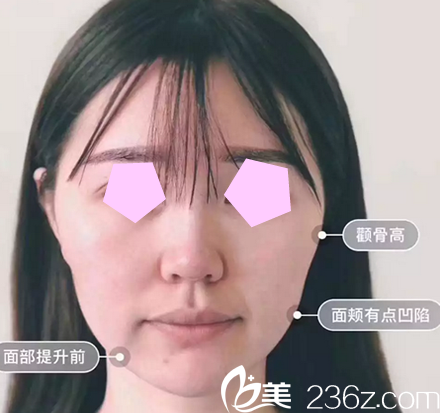 我在太原華美整形美容醫(yī)院做面部線雕術(shù)前照 我在太原華美整形美容醫(yī)院做面部線雕術(shù)前照