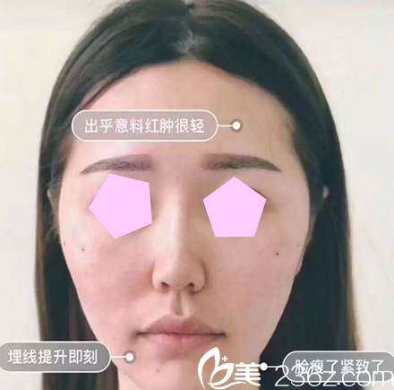 我在太原華美做面部線雕提升術(shù)后當(dāng)天照片 我在太原華美做面部線雕提升術(shù)后當(dāng)天照片