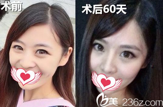 福華整形鼻綜合前后對比照
