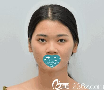 紅妝尚自體軟骨隆鼻術(shù)前照 紅妝尚自體軟骨隆鼻術(shù)前照