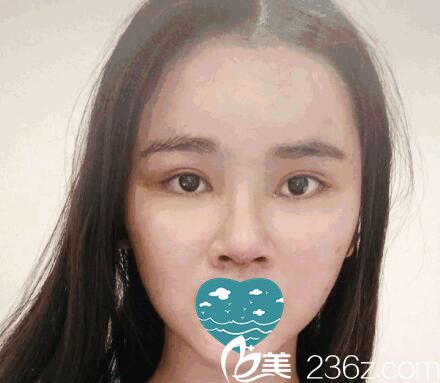 在三亞紅妝尚做自體軟骨隆鼻一周拆線 在三亞紅妝尚做自體軟骨隆鼻一周拆線