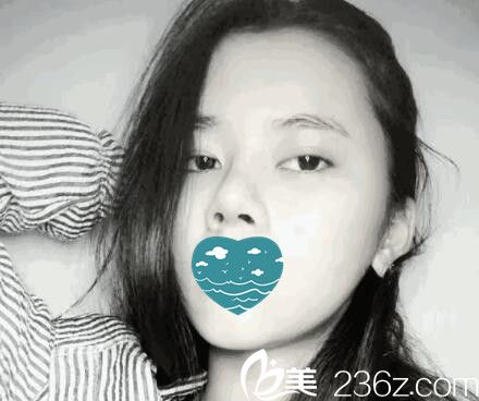 自體軟骨隆鼻第九天照 自體軟骨隆鼻第九天照