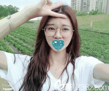 在紅妝尚做自體軟骨隆鼻半個月照 在紅妝尚做自體軟骨隆鼻半個月照