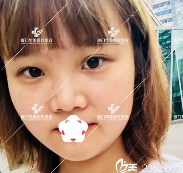 我在廈門華美整形醫(yī)院做隆鼻術(shù)前照 我在廈門華美整形醫(yī)院做隆鼻術(shù)前照