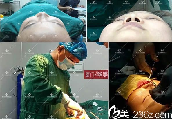 鼻綜合隆鼻手術(shù)過程圖 鼻綜合隆鼻手術(shù)過程圖