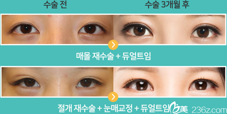 白院長眼部整形前后對比 白院長眼部整形前后對比