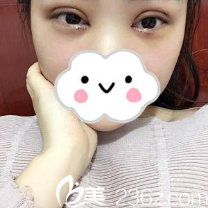 雙眼皮手術(shù)第三天