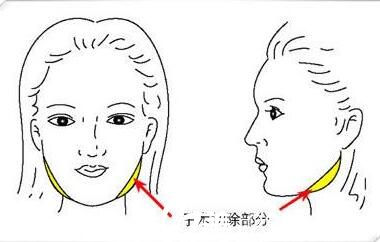 韓國(guó)快樂整形外科鄭哲賢面部輪廓手術(shù)方法