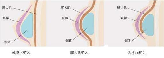 韓國(guó)快樂(lè)整形外科鐘泰元假體隆胸原理