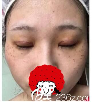 一周拆線雙眼皮恢復(fù) 一周拆線雙眼皮恢復(fù)