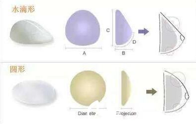 韓國(guó)快樂(lè)整形外科鐘泰元假體隆胸形狀