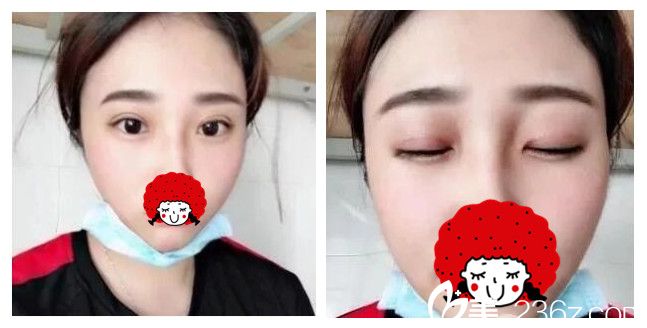 淮安華美雙眼皮+祛斑一起做 只要20天就能告別20多年的小眼麻子臉