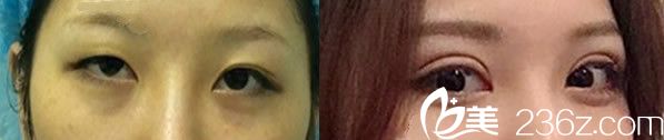 方暖碩雙眼皮全切手術(shù)代表案例