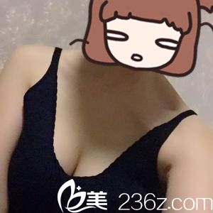 終于決定在衡陽曹家整形醫(yī)院做自體脂肪隆胸，一個(gè)月前后對比我都驚呆了