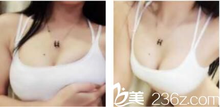 韓國(guó)快樂隆胸技術(shù)好不好？三個(gè)月前找鐘泰元做假體隆胸現(xiàn)在手感特別的柔軟