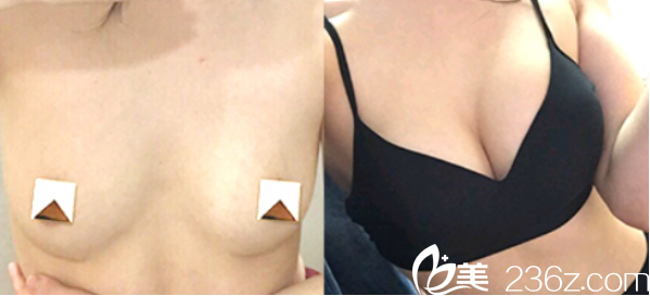豐胸對(duì)比案例 豐胸對(duì)比案例