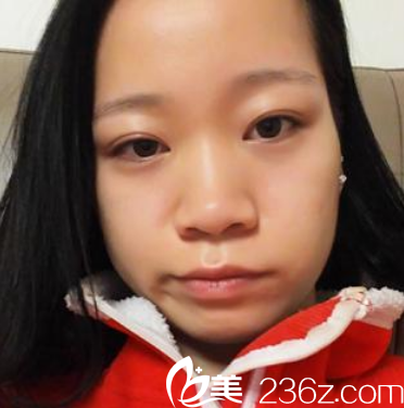 來廣州曙光整形醫(yī)院整形術前 來廣州曙光整形醫(yī)院整形術前