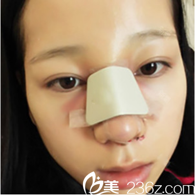 廣州曙光整形醫(yī)院范思軍隆鼻術后7天 廣州曙光整形醫(yī)院范思軍隆鼻術后7天