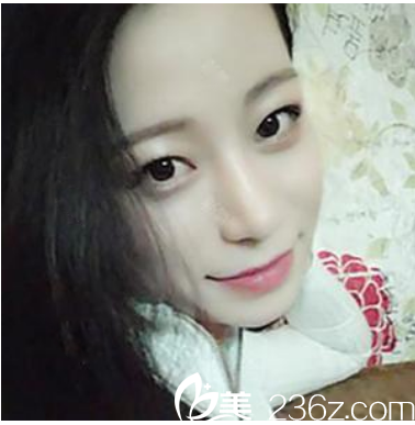 廣州曙光整形醫(yī)院范思軍鼻綜合隆鼻案例術后三個月 廣州曙光整形醫(yī)院范思軍鼻綜合隆鼻案例術后三個月