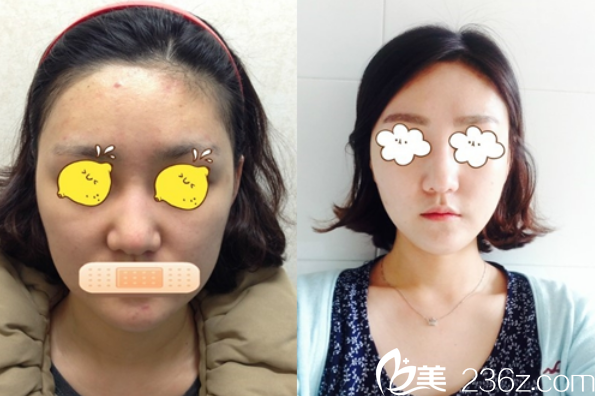 抗衰老技術前后對比 抗衰老技術前后對比