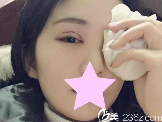 雙眼皮的恢復(fù)過程，術(shù)后第二天
