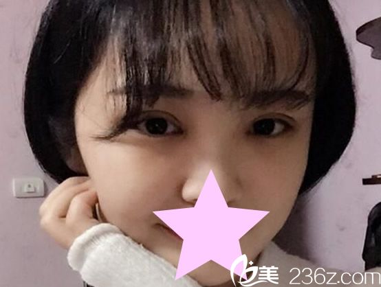 全切雙眼皮7-15天恢復(fù)圖片