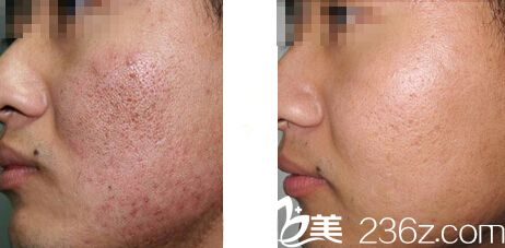 激光祛痘印真人案例