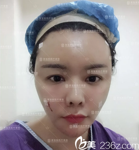 找深圳美加美陳群做完面部脂肪填充術(shù)后即刻效果圖 找深圳美加美陳群做完面部脂肪填充術(shù)后即刻效果圖