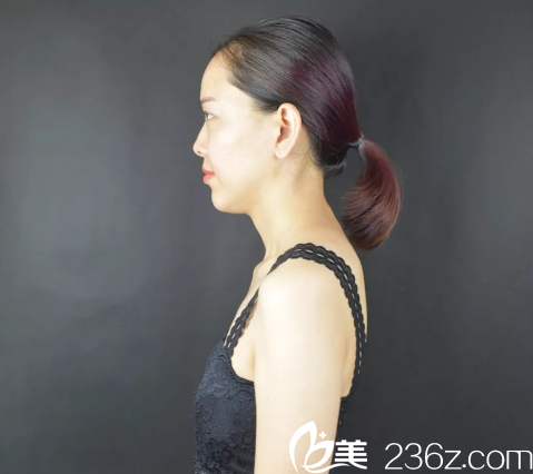 深圳雅涵整形醫(yī)院高山隆胸術(shù)前 深圳雅涵整形醫(yī)院高山隆胸術(shù)前