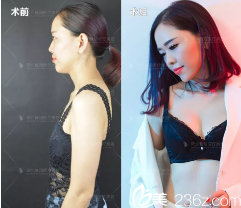 深圳雅涵整形醫(yī)院高山隆胸案例對比圖 深圳雅涵整形醫(yī)院高山隆胸案例對比圖
