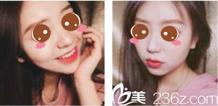 半年前去韓國樂世里找金弘承做了面部線雕提升，術(shù)后效果特別自然感覺較少年輕五歲