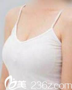 韓國一美知整形外科隆胸效果圖 韓國一美知整形外科隆胸效果圖