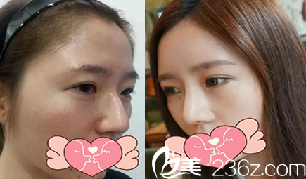 太原時光隆鼻術(shù)前術(shù)后效果對比圖