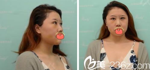 在杭州瑞麗做眼鼻脂肪填充4天效果