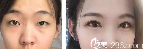 蘭州韓美雙眼皮+開眼角效果案例