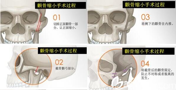 韓國李斗榮美笑整形外科李斗榮顴骨整形 韓國李斗榮美笑整形外科李斗榮顴骨整形