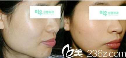 下頜角真人前后對比照 下頜角真人前后對比照