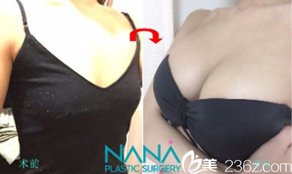 黃銅淵院長(zhǎng)復(fù)合隆胸前后效果案例 黃銅淵院長(zhǎng)復(fù)合隆胸前后效果案例