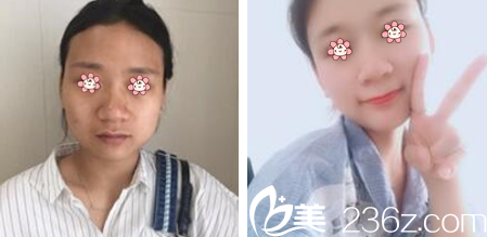 鄭宰學(xué)院長(zhǎng)下頜角整形案例