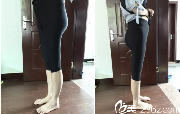 在韓國THE整形醫(yī)院做腿部吸脂第8天效果