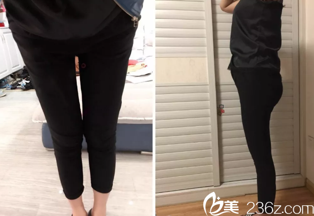 韓國THE整形外科醫(yī)院金洙喆腿部吸脂第13天效果