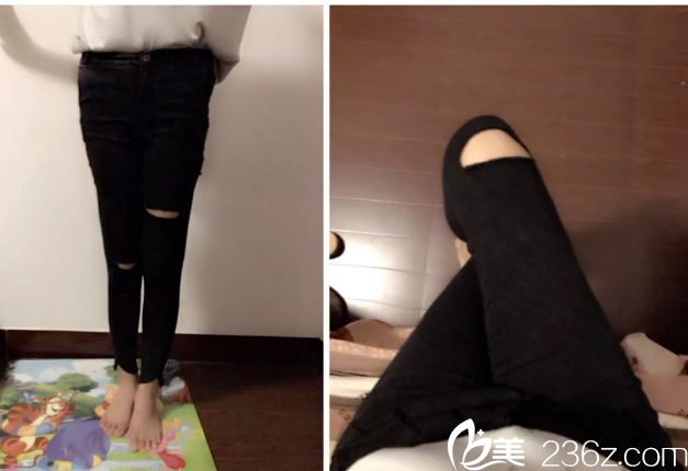 金洙喆腿部吸脂案例