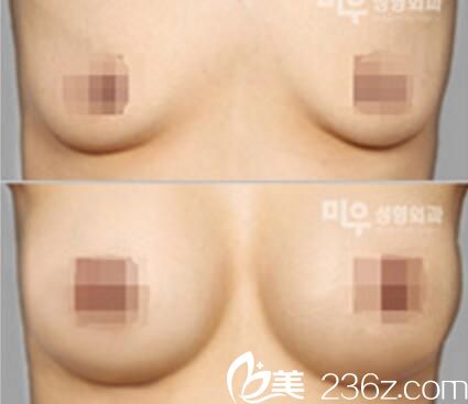 假體豐胸前后對比