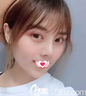 趁著暑期有整形優(yōu)惠找邢臺博愛高玉偉做了肋骨隆鼻+耳軟骨墊鼻尖 恢復(fù)22天后我的小翹鼻宛若天生