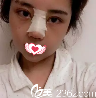 剛做完鼻綜合鼻子腫脹