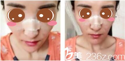 韓國李斗榮美笑整形外科李斗榮假體隆鼻真人案例術(shù)后第三天 韓國李斗榮美笑整形外科李斗榮假體隆鼻真人案例術(shù)后第三天